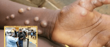 Varios países reportan aumento de casos de viruela del mono. Ministro López sobre contagios de viruela del mono en Perú: "Todavía no tenemos ni un caso"