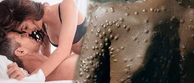 El infectólogo Leslie Soto se pronunció sobre los contagios de la viruela del mono Viruela del Mono: "No hay que besarse ni tener sexo con desconocidos"