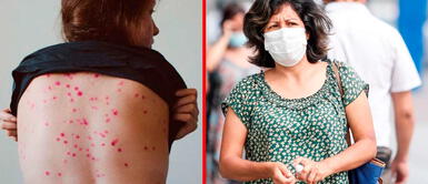 La viruela del mono es muy fácil de propagarse Viruela de mono: ¿Es más peligrosa y contagiosa que la COVID-19?