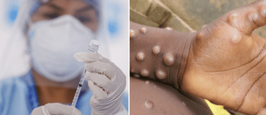 Existe un fármaco contra la viruela del mono. "La vacuna tiene el 85% de eficacia", según infectólogo del INS sobre viruela del mono