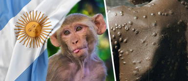 Viruela del mono: Argentina confirma su primer caso sospechoso Viruela del mono: Argentina confirma su primer caso sospechoso