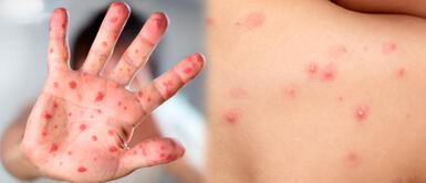 Hay más de 200 de casos positivos de viruela de mono en Europa Elmer Huerta: "La cadena de contagios en España se dio en un sitio donde hombres tienen encuentros íntimos"