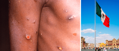 México confirma primer caso de viruela del mono en el país México confirma primer caso de viruela del mono en el país