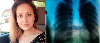 Kulikova se enteró a los 14 años de edad que su corazón estaba en la parte derecha Increíble: mujer tiene sus órganos ubicados al revés