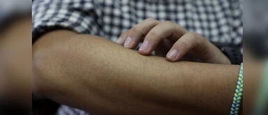 La viruela del mono es conocida como viruela símica. Chile confirma detección del primer caso de viruela del mono en el país