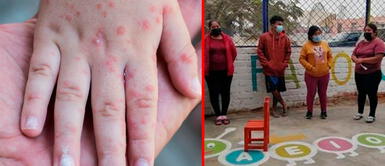 Dicha enfermedad también se le conoce como el virus Coxsackie. Chincha: preocupación en colegio inicial por posibles casos del síndrome mano-pie-boca
