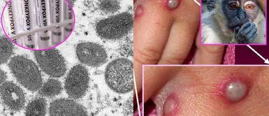 Perú confirma primer caso de viruela de mono y la llegada de la cuarta de coronavirus. Perú confirma primer caso de viruela de mono y la llegada de la cuarta de coronavirus.