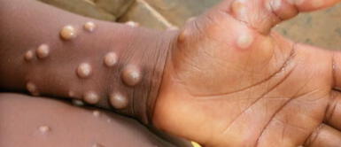 El Ministerio de Salud confirmó dos nuevos casos de viruela del mono. Viruela del mono: se confirma que el Perú está en una 'transmisión comunitaria'