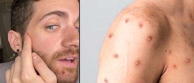 Matt Ford señaló que el pasado 17 de junio dio positivo a la prueba de la viruela del mono. Tuvo COVID-19 dos veces, pero afirmó que la viruela del mono es "mucho peor" | VIDEO