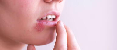 El Beso de araña puede ser curado con remedios caseros. ¿Cómo eliminar el 'beso de araña' con remedios naturales desde casa?