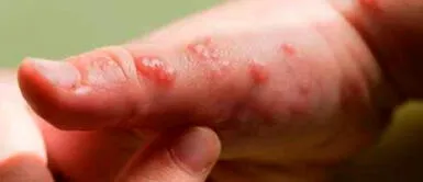 El Minsa confirmó que todos los pacientes de la viruela del mono ya recibieron asistencia médica Viruela del mono: Minsa confirma que el país ya cuenta con 55 casos positivos