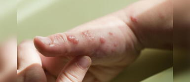 Conoce el periodo de incubación de la viruela del mono. Estados Unidos detecta por primera vez casos de viruela del mono en infantes