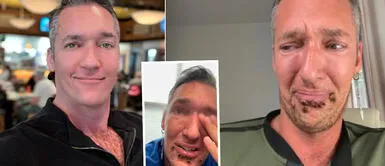 El hombre vive en Texas, que ya cuenta con 183 infectados por dicha enfermedad. Infectado con viruela del mono padece sus peores días: "Me duele existir"