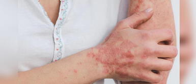 Conoce cómo prevenir los contagios por viruela del mono. Minsa: Aumentan contagios por viruela del mono a 305 en el país