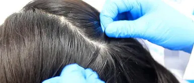 Recomendaciones para evitar la dermatitis seborreica. ¿Cómo afecta el estrés en tu rostro y cuero cabelludo? Dermatóloga explica