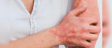 Conoce cómo prevenir los contagios por viruela del mono. Viruela del mono: Aumentan a 583 los casos confirmados en el país