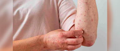 Conoce cómo prevenir la viruela del mono. Piura: Hombre de 27 años con viruela del mono tuvo contacto con 15 personas