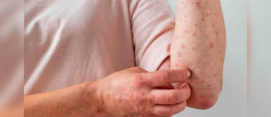 Conoce qué hacer si tienes un familiar con viruela del mono. Contagios de viruela del mono incrementaron un 20% en siete días, según la OMS