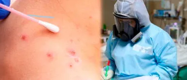 Hombre tuvo relaciones sexuales sin preservativo y luego contrajo tres enfermedades Hombre viajó a España y contrajo COVID-19, viruela del mono y VIH al mismo tiempo