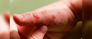 Los casos confirmados en Perú llegaron a 1,463. Minsa reporta primer caso de viruela del mono en un infante en el país