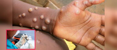 Conoce cómo prevenir la viruela del mono. Minsa: Vacunas contra viruela del mono llegarán al Perú en setiembre