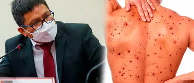 El ministro de Salud, Jorge López, confirmó que en setiembre llegarán vacunas contra la viruela del mono Ministro de Salud sobre la viruela del mono: "La única medida es la prevención"