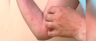 Conoce cómo prevenir el contagio de viruela del mono. Madre de Dios reporta primer caso de la viruela del mono en un joven