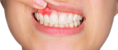 Conoce la técnica de cepillado bucal. La gingivitis puede afectar el hueso del diente de no tratarse a tiempo, según especialista