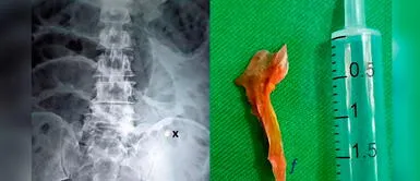 El sujeto fallecido presentó varios síntomas por días. Hombre de 60 años fallece tras ingerir espina de pescado de 2cm