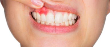 Conoce cómo evitar los males en dientes. Mal estado de dientes puede generar problemas cardiacos y agravar otros males