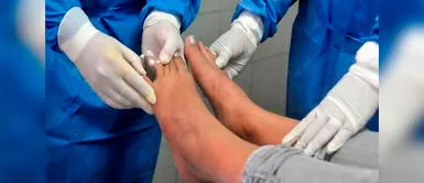 Conoce las etapas de adaptación. Problemas de corazón, diabetes y cáncer pueden terminar en amputación, alerta especialista