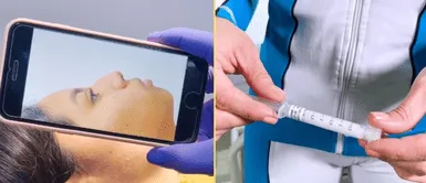 Especialista revela el uso del metacrilato. ¿Qué es el metacrilato? La sustancia que podría desfigurar a pacientes con lesiones permanentes