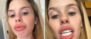 Mujer se pone carillas dentales y se viraliza el resultado: Parezco un maldito caballo Mujer se pone carillas dentales y se viraliza el resultado: "Parezco un maldito caballo"