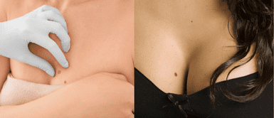 Los lunares en el cuerpo pueden tener muchos significados y razones para las mujeres. ¿Sabes por qué aparecen lunares en los senos y qué significan?