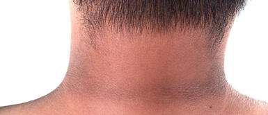 Conoce las peligrosas causas del cuello negro. ¿Por qué tengo el cuello negro y como se quita?