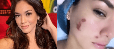 Jazmín Pinedo sufre quemaduras por crema JAZMÍN PINEDO sufre QUEMADURAS en el rostro al usar crema: “Espero no me queden secuelas”
