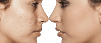 Técnica para ocultar el acné: Sigue estos tips y consigue una piel radiante Técnica para ocultar el acné: Sigue estos tips y consigue una piel radiante