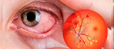 Uno de cada cuatro diebéticos en el Perú desarrollarían Retinopatia Diabética Uno de cada cuatro diebéticos en el Perú desarrollarían Retinopatia Diabética