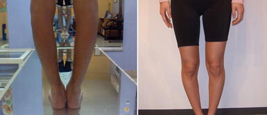 Las piernas arqueadas son conocidas como 'genu varo'. Piernas arqueadas: conoce por qué algunas personas tienen el 'genu varo'