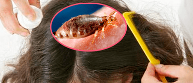 Niña de 12 años muere luego de que sus padres le aplicaran sustancia para combatir los piojos Niña de 12 años muere luego de que sus padres le aplicaran sustancia para combatir los piojos