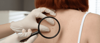 Expertos buscan detectar de manera precoz el cáncer de piel. Día del lunar: Cada año se diagnostican 1300 nuevos casos de cáncer de piel melanoma