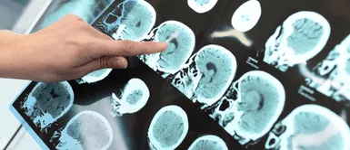 Conoce de qué trata el Alzhéimer y sus síntomas. Expertos chinos informan de primer caso de paciente de 19 años con Alzhéimer