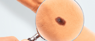 Conoce qué es el cáncer de piel. ¿Cómo identificar un lunar peligroso? Oncóloga lo explica