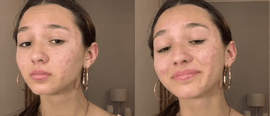 Ale Barnechea muestra su rostro con acné Alexia Barnechea muestra que sufre de acné por problemas personales: “He pasado por mucho emocionalmente"