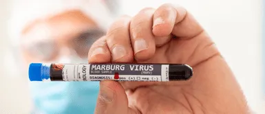 Conoce los síntomas del virus de Marburgo. El brote de Marburgo en Guinea Ecuatorial no debe causar pánico, advierte África CDC