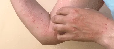 Conoce los síntomas de la viruela del mono. Identifican una nueva forma severa de la viruela del mono con alta mortalidad