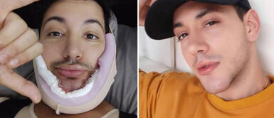 Jean Paul Santa María se sometió a procedimiento estético. Foto: Instagram Jean Paul Santa María se somete a un 'retoquito' y sorprende a sus seguidores en Instagram: “Adiós mentón gigante”