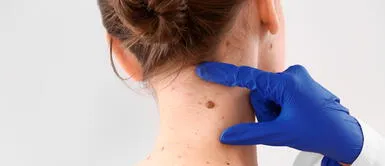 Conoce los signos de un lunar peligroso. ¿Cuándo debemos preocuparnos por un lunar?