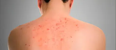 Se estima que unas 835 personan padecen la enfermedad de Fabry en el Perú Conoce más sobre Fabry, la enfermedad con múltiples caras