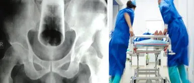 Sujeto termina emergencias vaso en el recto Hombre termina en urgencias tras insertarse un vaso por el recto